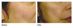 skin lightening before and after photo houston tx