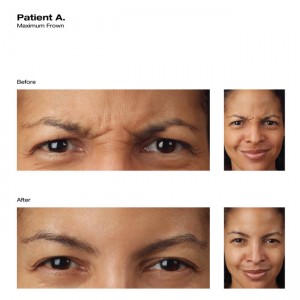 botox before and after patient houston tx