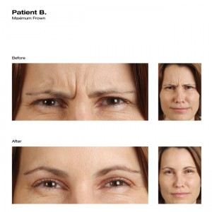 botox before and after photo houston tx 