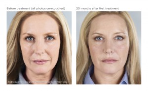 Sculptra Before and After Photo Houston TX