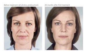 Sculptra Before and After Photo Houston TX