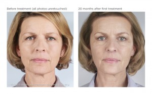 Sculptra Before and After Photo Houston TX