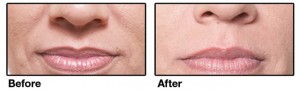 Restylane Lips Before and After Houston TX | Dr Esta Kronberg