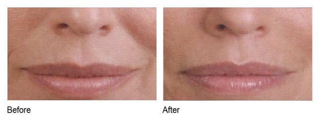 juvederm before and after photo houston tx