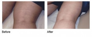 stretch mark treatment before and after patient houston tx