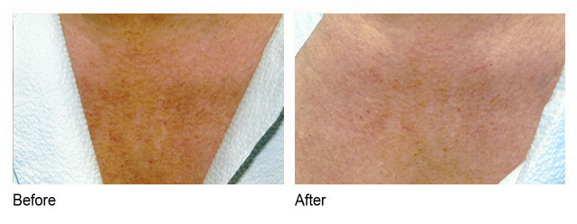 IPL Photofacial treatment for the chest before and after in Houston Texas