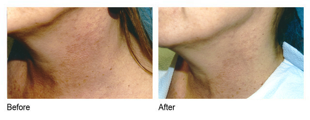 IPL Photofacial Before and After Treatment Houston TX | Dr Esta Kronberg 