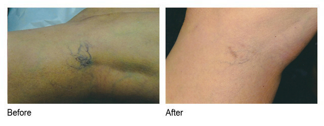 sclerotherapy before and after photo houston tx | spider vein removal