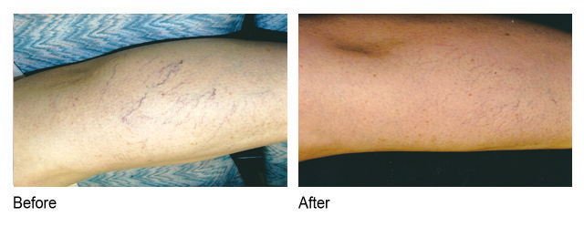 sclerotherapy before and after photo houston tx | spider vein removal