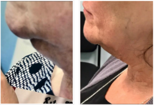 Kybella before and after patient in Houston TX