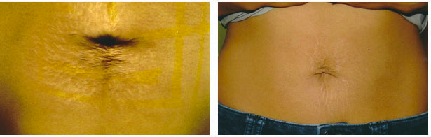 Stretch marks before and after | Esta Kronberg TX
