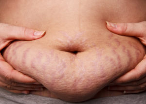 Treatment for Stretch Marks in Houston TX