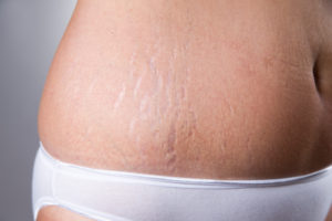 Stretch Marks Treatment Houston, TX