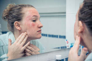 General Dermatology Houston TX | Eczema Treatment