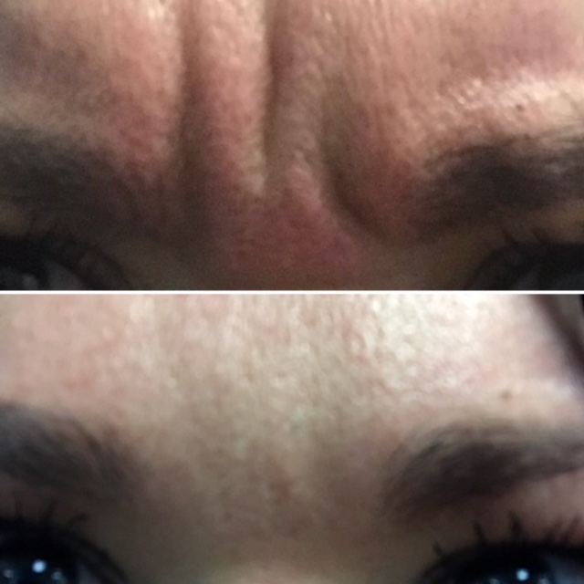 Botox Before & After Photo - Houston TX - Dr. Esta Kronberg