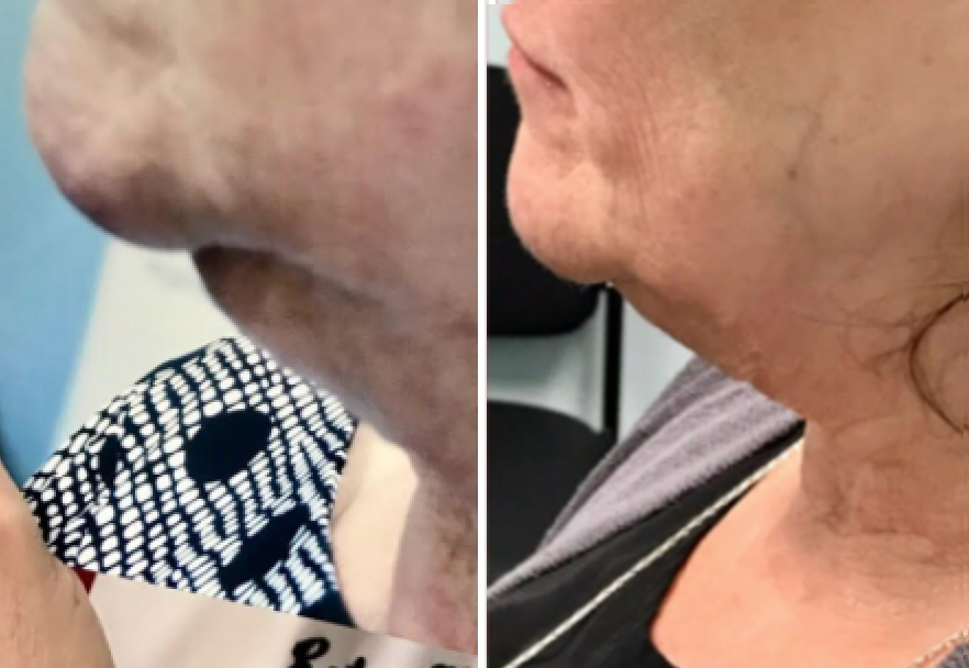 Kybella before and after photo houston tx