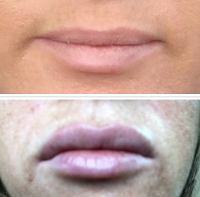 juvederm for lips before and after photo houston tx