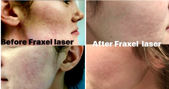 Fraxel Before & After Photo Houston TX