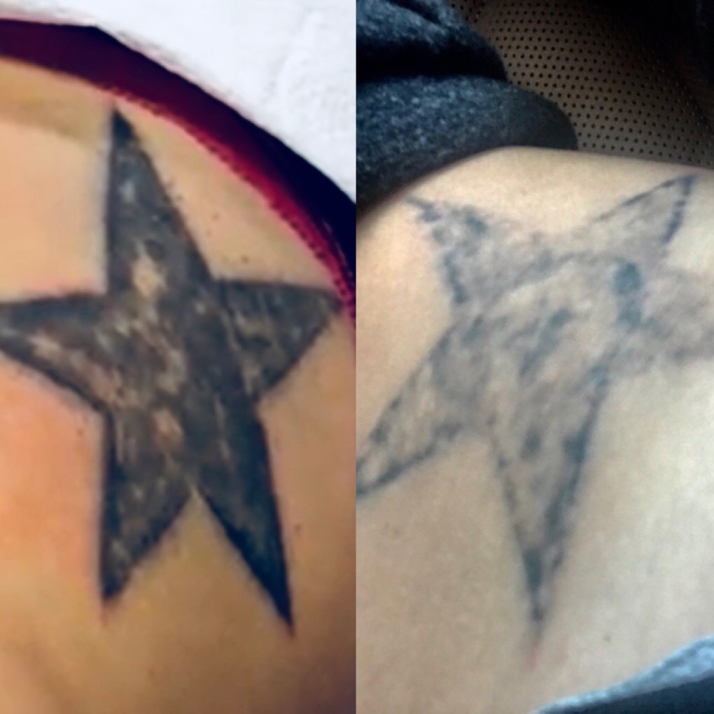 Adelaides best laser tattoo removal and fading service with exceptional  results  The Tattoo Removal CoLaser Tattoo Removal Adelaide