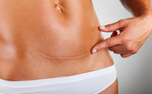 Houston Surgical Scar Removal