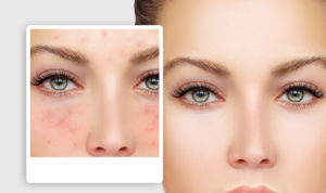 Rosacea skin treatment