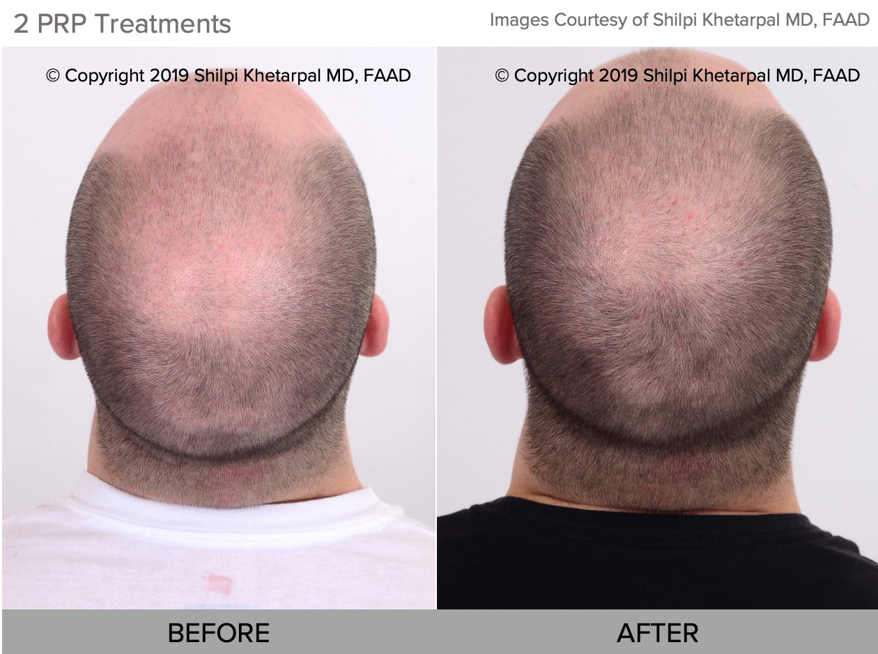 PRP before and after photo houston tx 