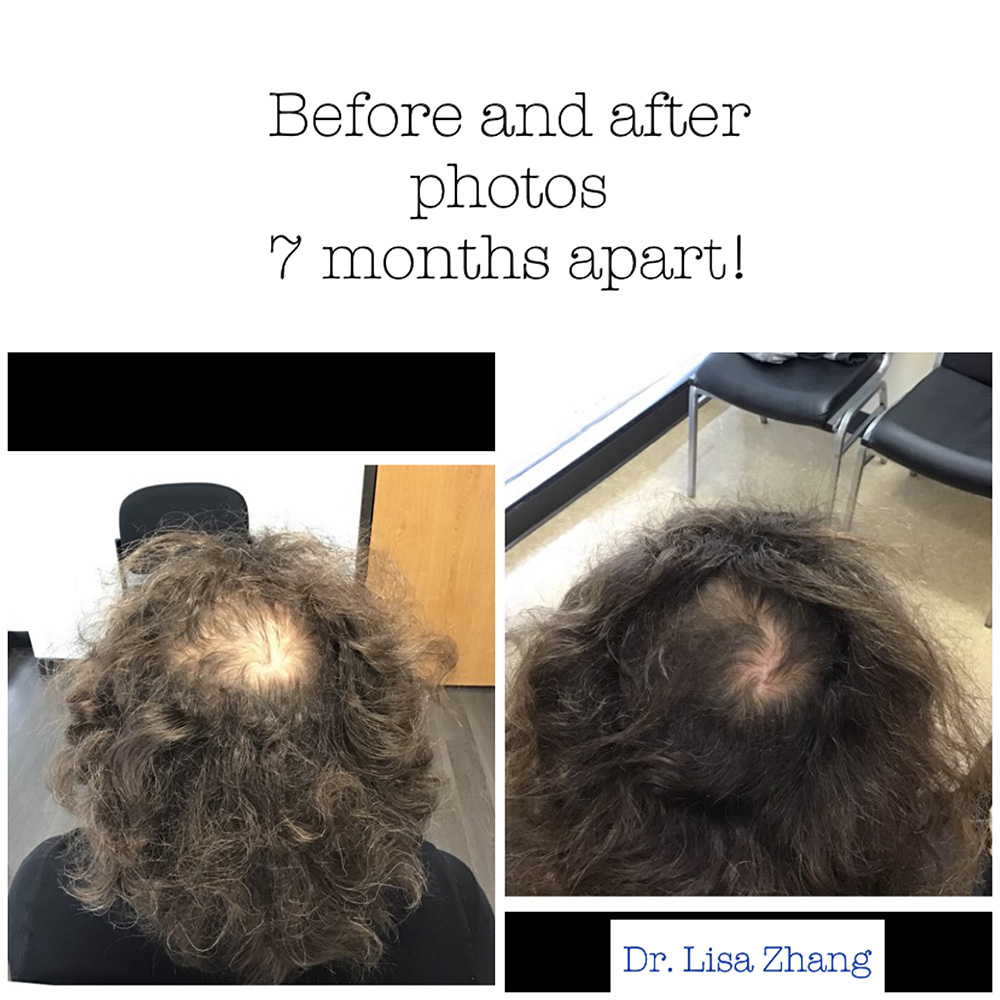 Hair Loss Topical Treatment before and after gallery houston tx