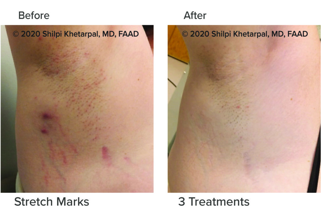 Before & After Microneedling