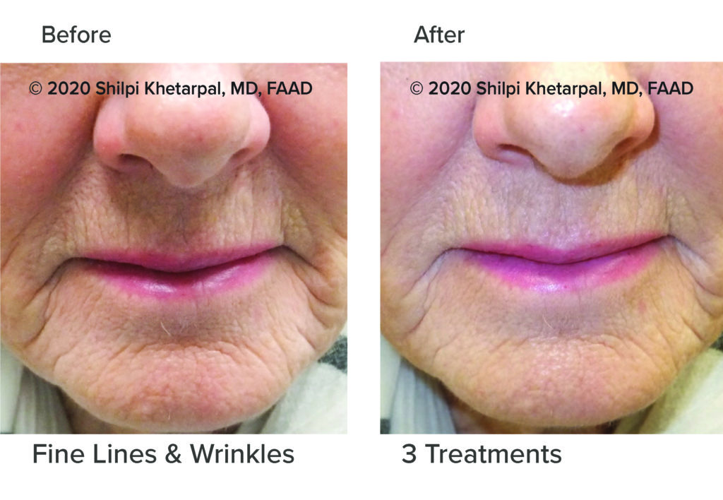 Before & After Microneedling