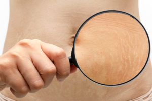 Stretch marks the abdomen through a magnifying glass.