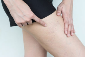 Women showing varicose and spider veins on the skin of leg