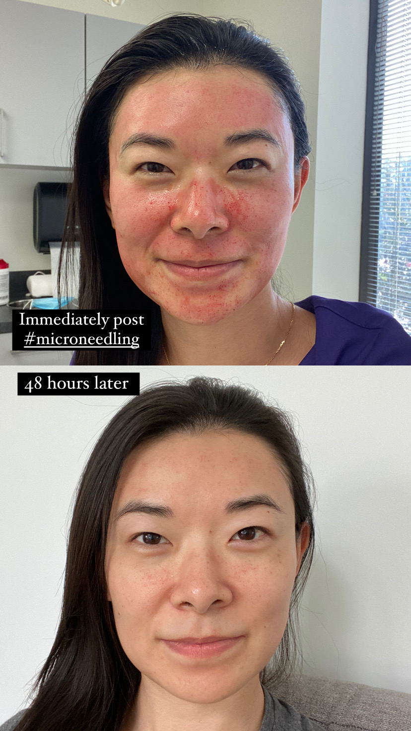 Microneedling Before and After