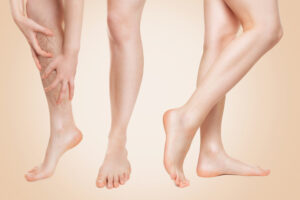 sclerotherapy