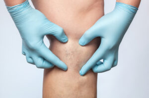 A close-up shot of a doctor examining a patient’s spider veins during a sclerotherapy consultation